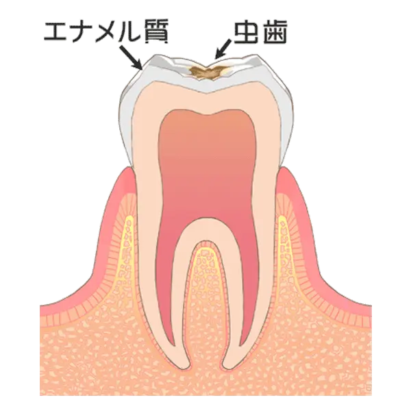 歯の表層（エナメル質）の虫歯