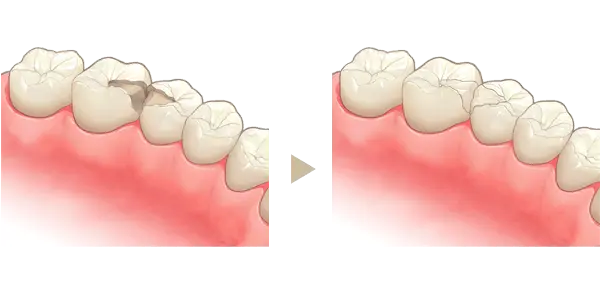 インレー（詰め物）