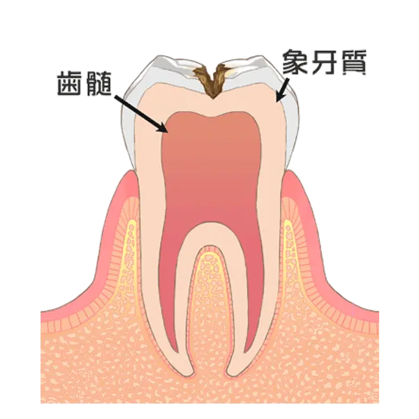 歯の中（象牙質）の虫歯