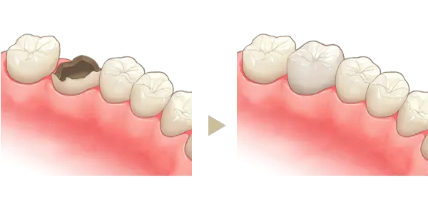 クラウン（被せ物）