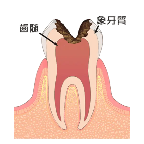 神経まで達した虫歯