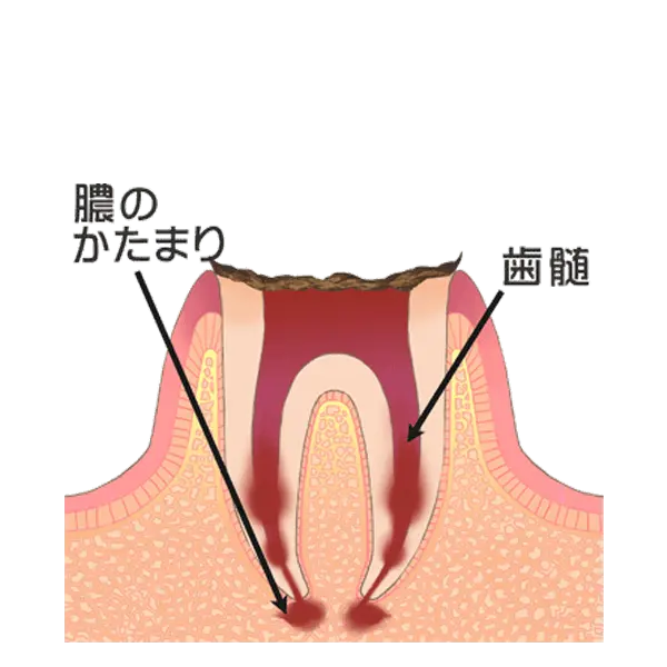 歯の根まで達した虫歯