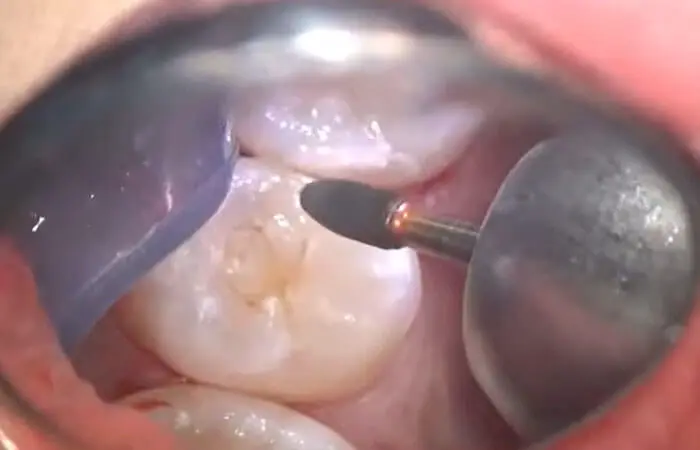 ダイレクトボンディング