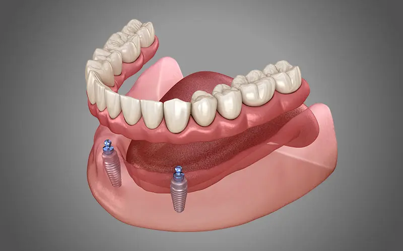 インプラントオーバーデンチャー