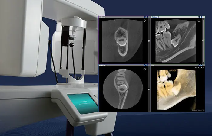 歯科用CTを用いた診断