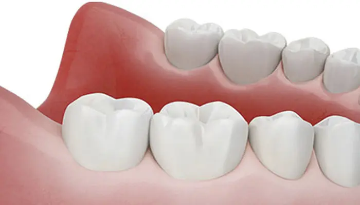 手術当日1日で自然な補綴まで