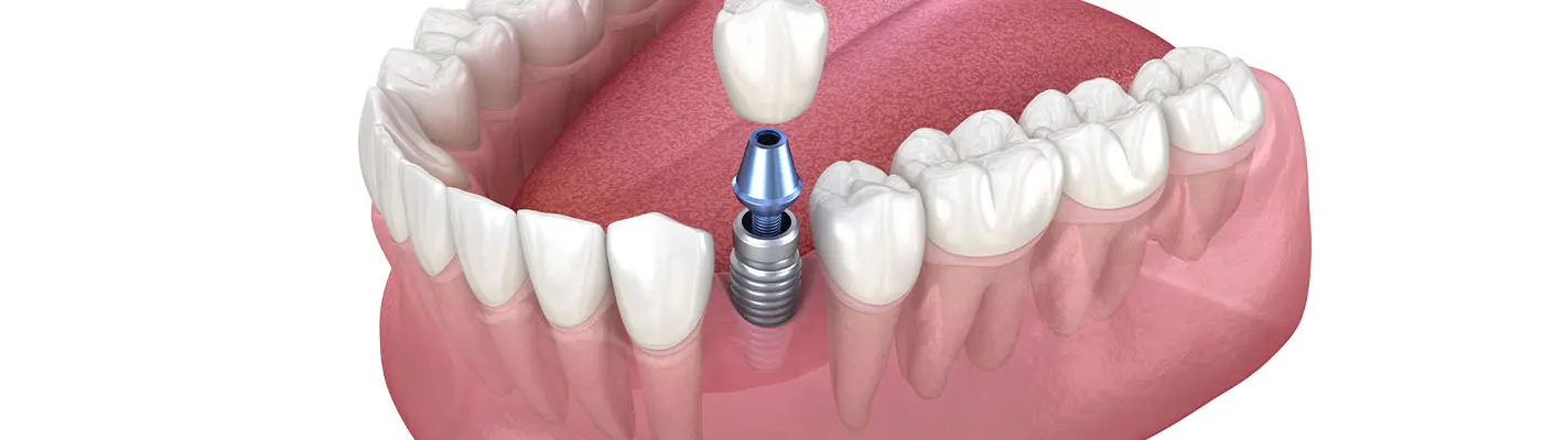 インプラント