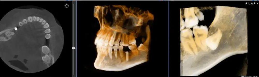 歯科用CT・デジタルレントゲン