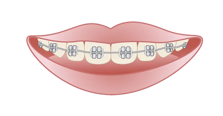 第Ⅱ期矯正治療