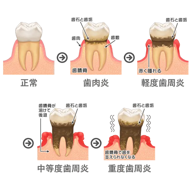 歯周病の進行